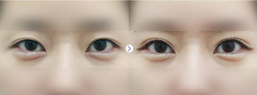 双眼皮手术后开眼角的疤痕怎么处理_双眼皮手术后可以用生理盐水清理吗