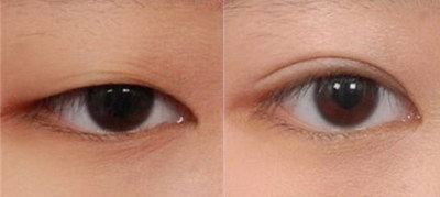 单眼皮与双眼皮的区别
