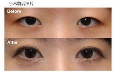 美瞳线会影响睫毛生长吗_用激光洗美瞳线会影响睫毛吗
