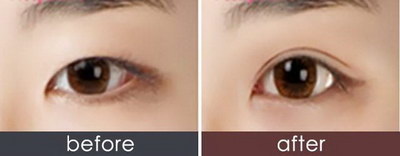 割完双眼皮大小眼明显正常吗_大小眼可以通过双眼皮改善吗