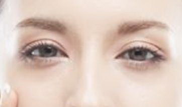 韩式双眼皮恢复要几天「韩式双眼皮几天能恢复」