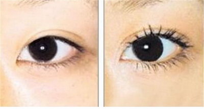 双眼皮肉条感怎么样可以消失「双眼皮肉条修复效果怎么样」