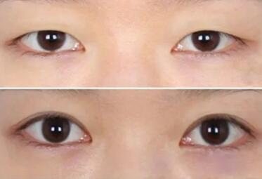 眼睑下垂手术会影响视力吗
