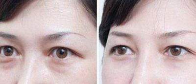 做双眼皮手术眼睛肿的_眼睛小能做双眼皮手术改善吗