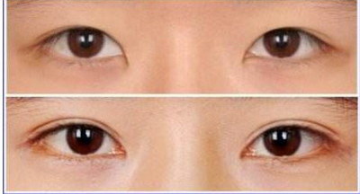 多点定位双眼皮过程图(多点定位双眼皮原理)