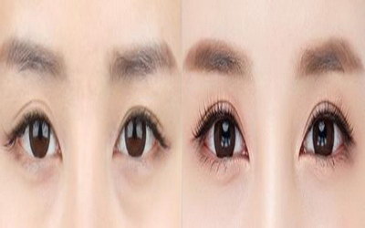 扇形双眼皮和平行双眼皮对比(扇形双眼皮和平行双眼皮图片对比)