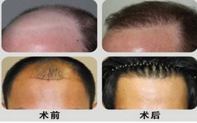 做完植发后多久可以洗头(植发后多久可以理发和洗头)
