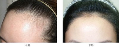 种植头发前后对比照片(种植头发前后对比照)