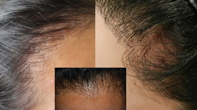 额头两侧发际线后移是什么原因_额头两侧发际线后移的治疗方案