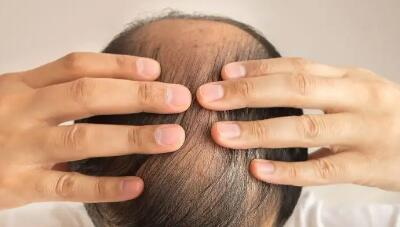 吃钙片可以防止掉头发吗_吃甲亢的药掉头发怎么办