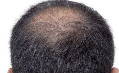 吃黑芝麻能让头发变浓密吗_卵磷脂可以促进头发生长吗