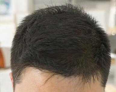 植发多久能正常_植发多久才能正常长头发