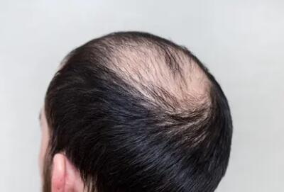 发际线植发会有后遗症吗