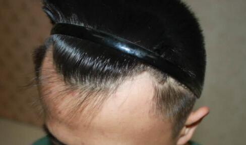 八个方法可以让头发变浓密怎样头发浓密_哺乳期可以种植头发吗