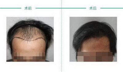 广州种植头发的价格怎么算【广州种植头发的价格】