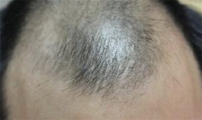 胸毛腿毛体毛多的原因(为什么某些男性身上毛发比较多？)
