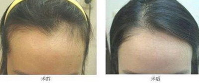 这条伤疤做植发手术要多少钱_额头前面头发稀疏做植发手术要多少钱