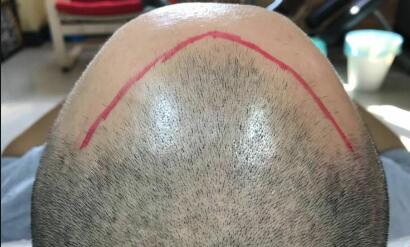 植发区头皮凸起是怎么回事(植发后头皮发痒是怎么回事)