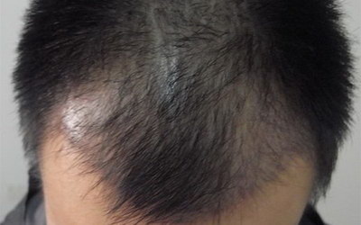 什么方法植发最好_宁波植发最好的康肤植发用的是什么方法