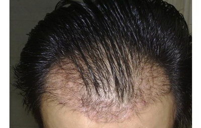 植发一般能管多久