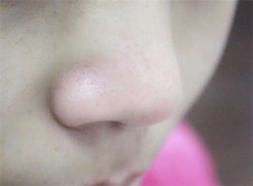 韩春民膨体隆鼻手术的缺点有哪些