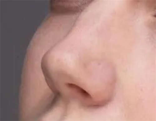 鼻综合手术后多久不痛,双十一哪里做鼻综合优惠呢？